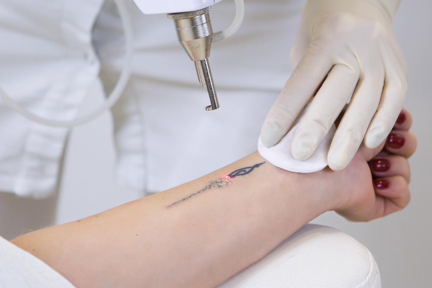 Laser Tattoo Removal Is Better Than Cosmetic Tattoo Removal