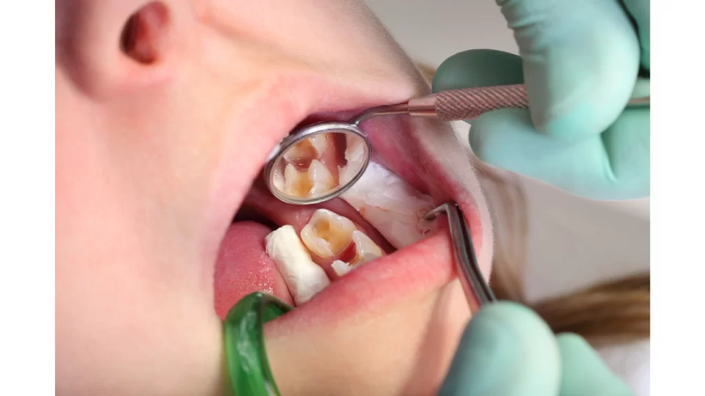 How much does a dental filling cost?
