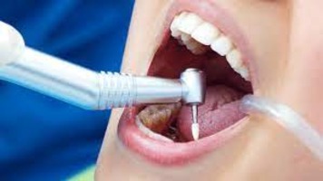 How to Prepare for a Successful Root Canal Treatment
