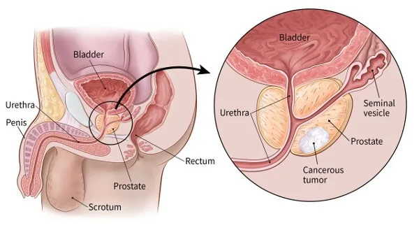 Lifestyle Choices and Prostate Cancer Risk Reduction