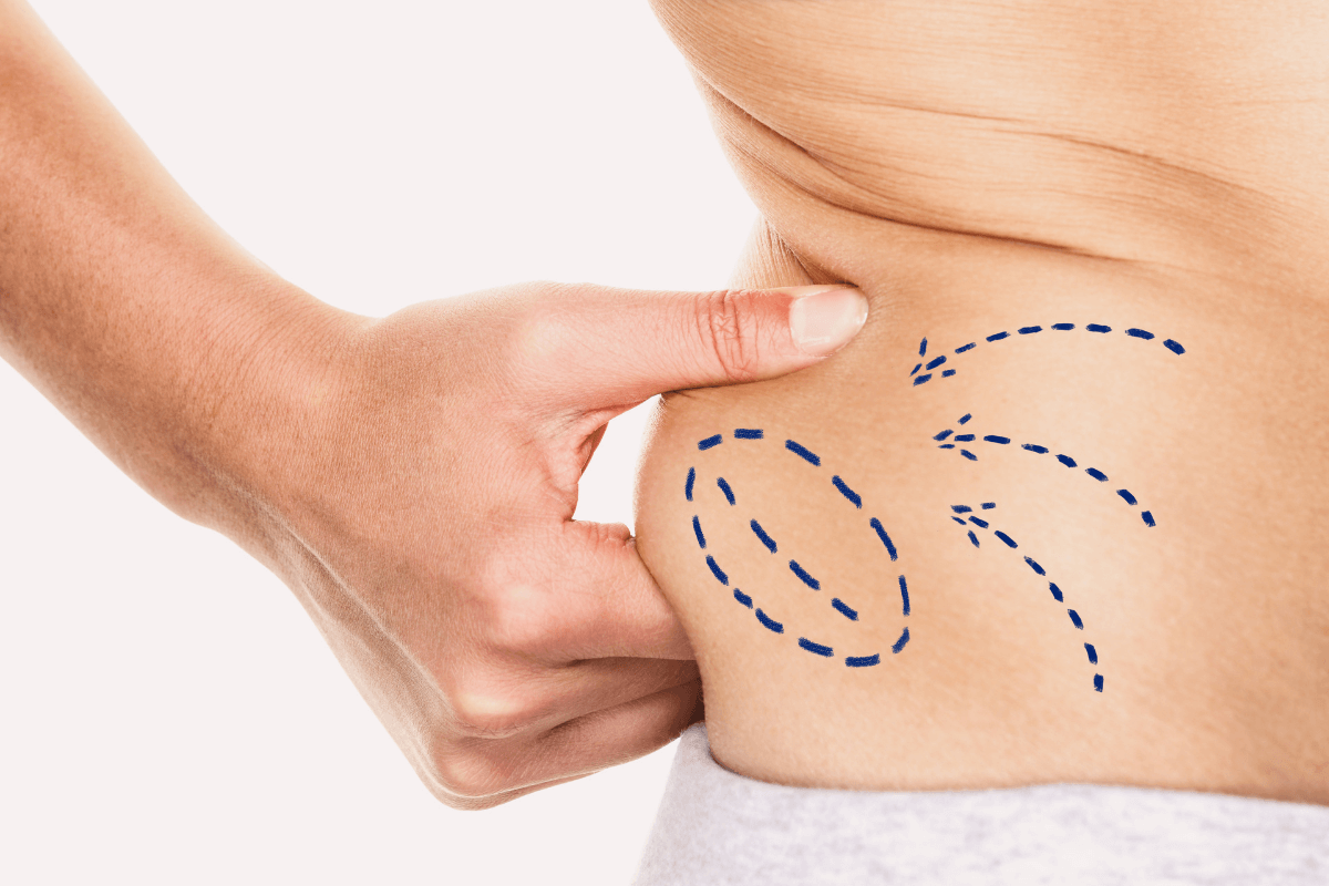 Say Goodbye to Stubborn Fat: Liposuction Trends in Dubai