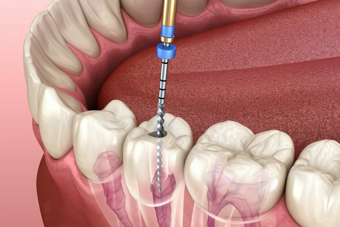 Unveiling the Secrets of Root Canal Treatment: A Comprehensive Guide