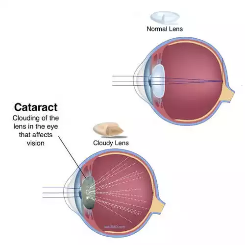 What is Cataract Surgery: Risks, Recovery, Costs