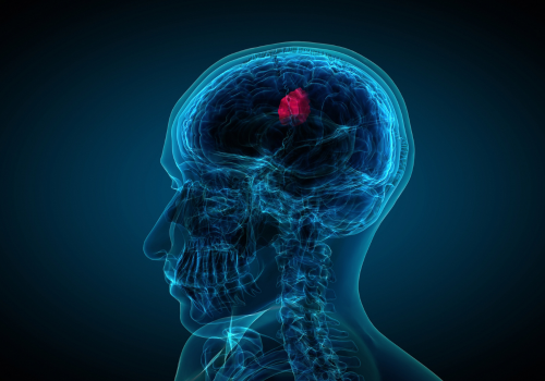 Brain Tumors and the Importance of Clinical Trials in Advancing Treatment.